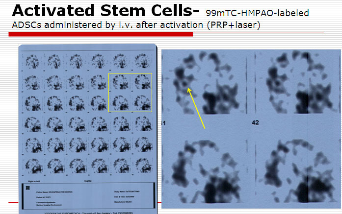 Radio-tagged stem cells on a patient with brain injury - Britannia Medical Center